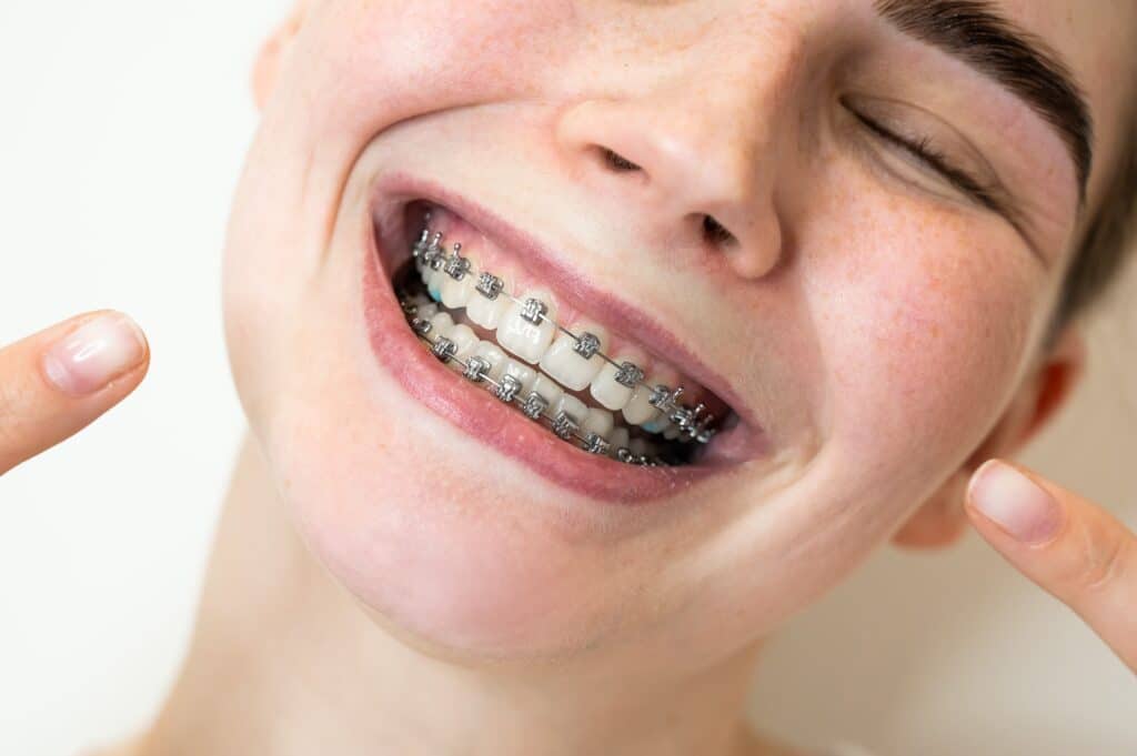 traditional braces near me